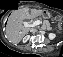 Portal Vein Thrombosis - Liver Case Studies - CTisus CT Scanning