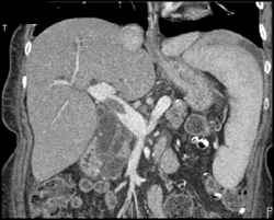 Portal Vein Thrombosis - CTisus CT Scan