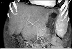 Cirrhosis With Large Varices (unopacified) - CTisus CT Scan