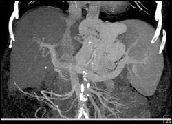 Cirrhosis With Varices - CTisus CT Scan