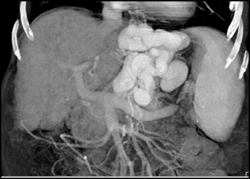 Huge Varices in Cirrhosis - CTisus CT Scan