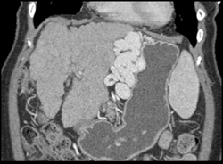 Cirrhosis With Varices - CTisus CT Scan