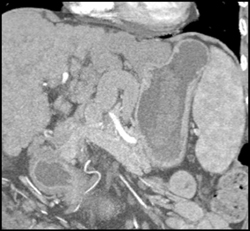 Cirrhosis With Varices - CTisus CT Scan