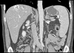 Hemangioma - CTisus CT Scan