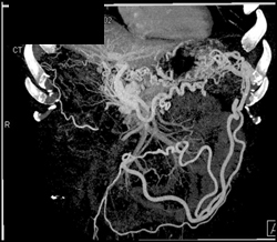 Cavernous Transformation of the Portal Vein - CTisus CT Scan