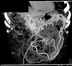 Cavernous Transformation of the Portal Vein - CTisus CT Scan