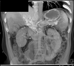 Cavernous Transformation of the Portal Vein (VRT) - CTisus CT Scan