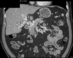 Cavernous Transformation of the Portal Vein - CTisus CT Scan