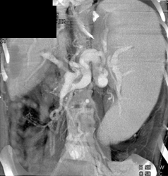 Liver Transplant With Infarct - CTisus CT Scan