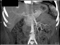 Hepatoma - CTisus CT Scan