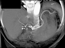 Hepatic Artery Stenosis - CTisus CT Scan