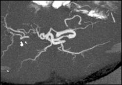 Hepatic Artery Stenosis in A Transplant Patient - CTisus CT Scan