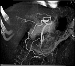 Normal Hepatic Artery - CTisus CT Scan