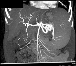 Normal Hepatic Artery - CTisus CT Scan