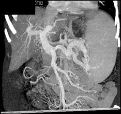 Portal Hypertension With A Large Spleen - CTisus CT Scan