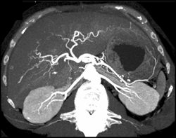 Incidental Hemangiomas - CTisus CT Scan