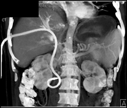 Klatskins Tumor - CTisus CT Scan