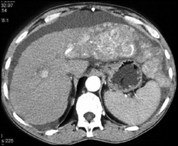 Hepatoma - CTisus CT Scan