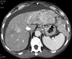 Hepatoma in A Cirrhotic Liver - CTisus CT Scan