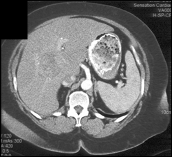 Hepatoma - CTisus CT Scan