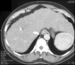 Cirrhosis - CTisus CT Scan