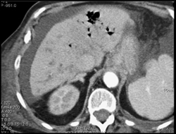 Liver Abscess With Air in Vascular System - CTisus CT Scan