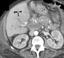 Portal Vein Thrombosis - CTisus CT Scan