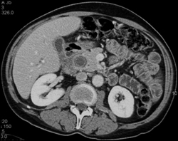 Impacted Stone in Common Bile Duct (CBD) - CTisus CT Scan