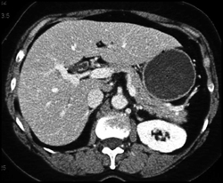 Thickened Common Bile Duct (CBD) Due to Cholangitis - CTisus CT Scan