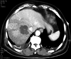 Liver Abscess With Flow Changes - CTisus CT Scan