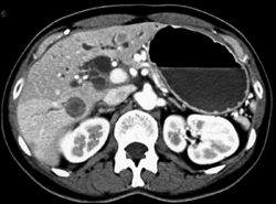 Pancreatic Cancer With Dilated Ducts - CTisus CT Scan