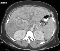 Periportal Edema and Focal Fat - CTisus CT Scan