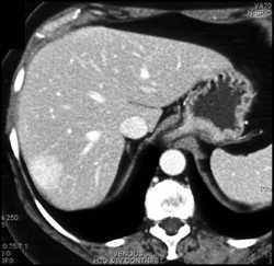 Hemangioma - CTisus CT Scan