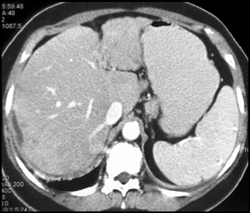 Hepatoma in Left Lobe of Cirrhotic Liver - CTisus CT Scan