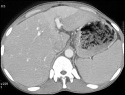 Av Shunting in Left Hepatic Lobe - CTisus CT Scan