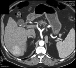 Hemangioma - CTisus CT Scan