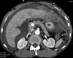 Bleed From Hepatoma S/P Biopsy - CTisus CT Scan