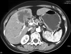 Cholangiocarcinoma - CTisus CT Scan