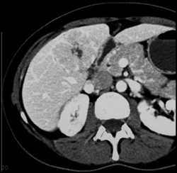 Focal Nodular Hyperplasia (FNH) - CTisus CT Scan