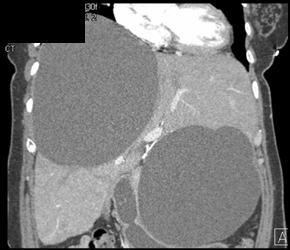 Hepatic Cysts Compress the Stomach - CTisus CT Scan