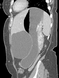 Hepatic Cysts - CTisus CT Scan