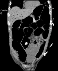 Portal Venous Air - CTisus CT Scan