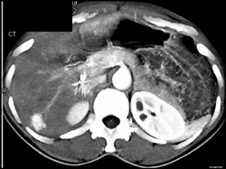 Hemangioma - CTisus CT Scan