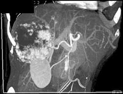 Hemangioma - CTisus CT Scan