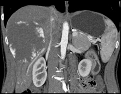 Hemangioma - CTisus CT Scan