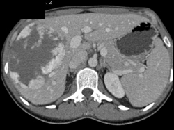 Hemangioma - CTisus CT Scan