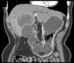 Cholangiocarcinoma - CTisus CT Scan