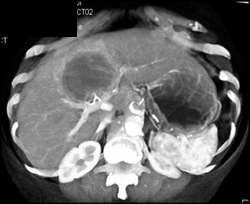 Cholangiocarcinoma - CTisus CT Scan