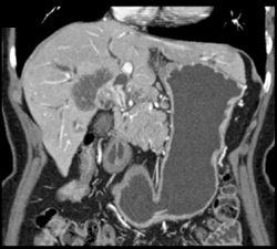 Cholangiocarcinoma - CTisus CT Scan