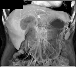 Cholangiocarcinoma - CTisus CT Scan